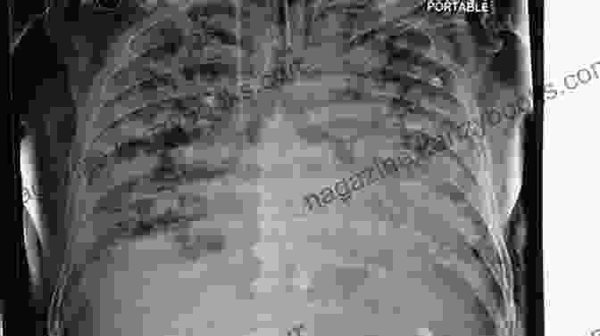 A Chest X Ray Of A Patient With ARDS A Simple Guide To Acute Respiratory Distress Syndrome Diagnosis Treatment And Related Conditions