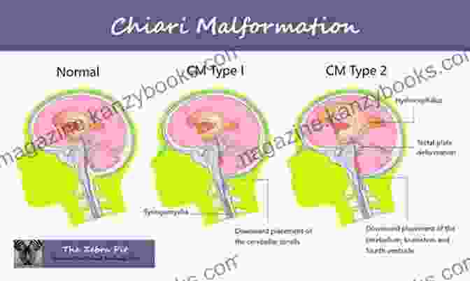 A Comprehensive Guide To Chiari Malformations, Their Diagnosis, Treatment, And Associated Conditions. A Simple Guide To Chiari Malformations Diagnosis Treatment And Related Conditions