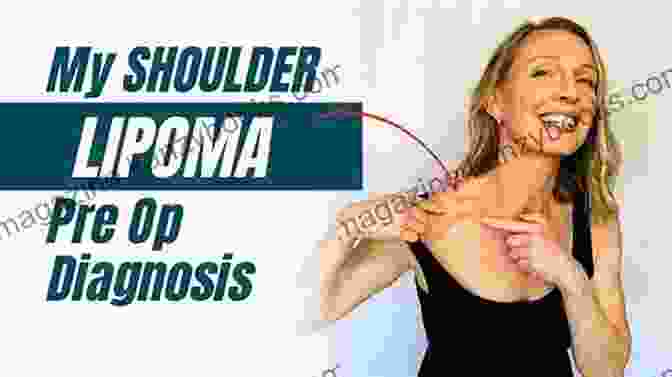 A Lipoma On The Shoulder Of A Person A Simple Guide To Lipomas Treatment And Related Diseases (A Simple Guide To Medical Conditions)