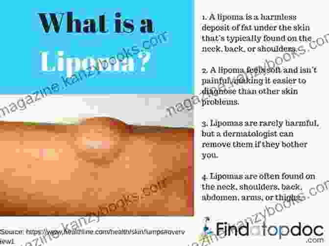 A Lipoma On The Thigh Of A Person A Simple Guide To Lipomas Treatment And Related Diseases (A Simple Guide To Medical Conditions)