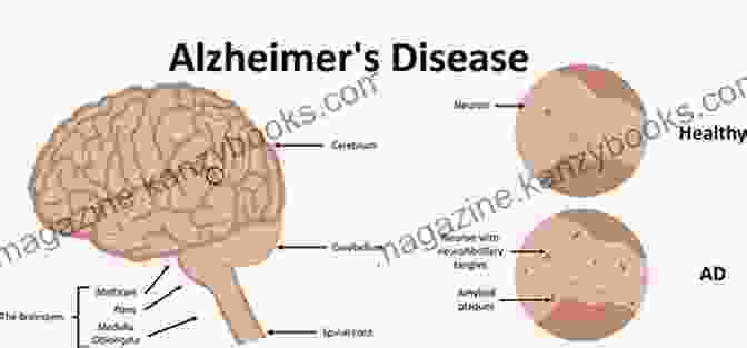 An Image Of An Alzheimer's Affected Brain Showing Plaques And Tangles Beating Alzheimer S The Enemy At The Gate: Turning Despair Into Hope And Action