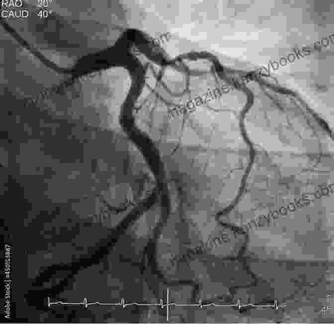 Angiogram Showing Narrowing In The Coronary Arteries A Simple Guide To Angioplasty (Stent Dilatation) Diagnosis Treatment And Related Conditions