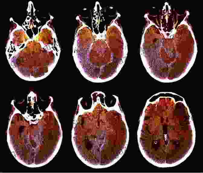 Brain Scan Showing Alzheimer's Disease Alzheimer S Treatment Alzheimer S Prevention: A Patient And Family Guide 2024 Edition