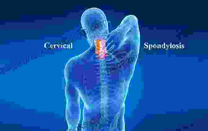 Cervical Spondylosis Affects The Bones, Ligaments, And Discs In The Neck A Simple Guide To Cervical Spondylosis Diagnosis Treatment And Related Conditions