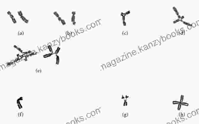 Diagnosis Of Fanconi Anemia Through Chromosomal Analysis A Simple Guide To Fanconi Anemia Diagnosis Treatment And Related Conditions