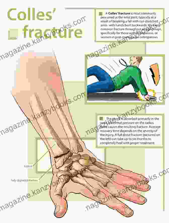 Diagram Of A Colles Fracture A Simple Guide To Colles Fracture (Broken Wrist) Diagnosis Treatment And Related Conditions (A Simple Guide To Medical Conditions)