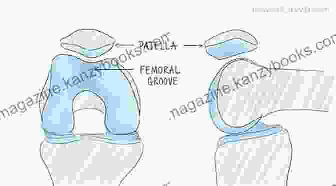 Diagram Of A Kneecap Dislocation, Showing The Kneecap (patella) Dislocated To The Outside Of The Knee A Simple Guide To Kneecap Dislocations Treatment And Related Diseases (A Simple Guide To Medical Conditions)