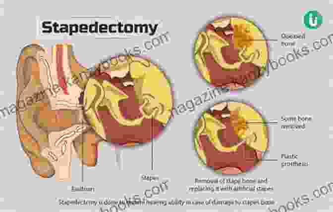 Diagram Of A Stapedectomy Procedure A Simple Guide To Otosclerosis (Thickened Ear Bones) Diagnosis Treatment And Related Conditions