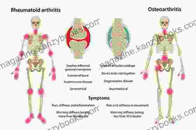 Diagram Of Juvenile Arthritis Affected Joints Living With Juvenile Arthritis: A Parent S Guide