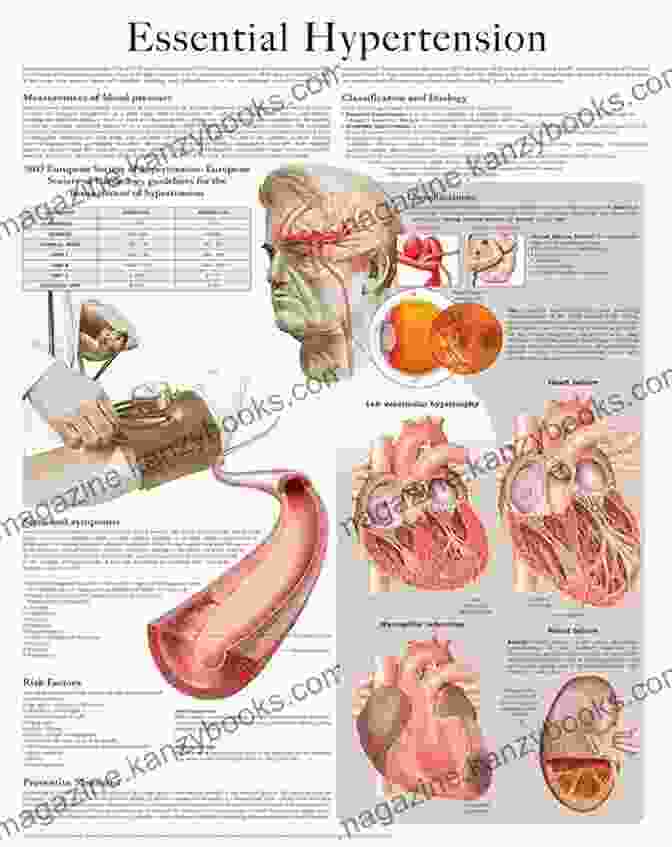 Essential Hypertension Chart Full Illustrated: A Detailed Guide To Understanding And Managing High Blood Pressure Essential Hypertension E Chart: Full Illustrated