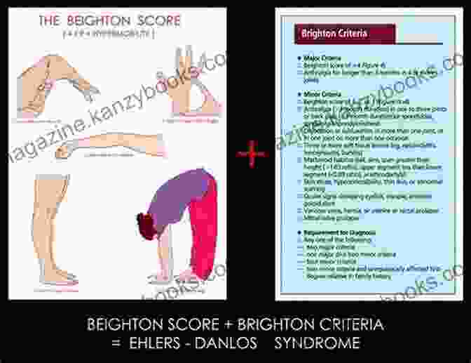 Illustration Demonstrating The Beighton Score Assessment Hypermobility Of Joints Peter Beighton