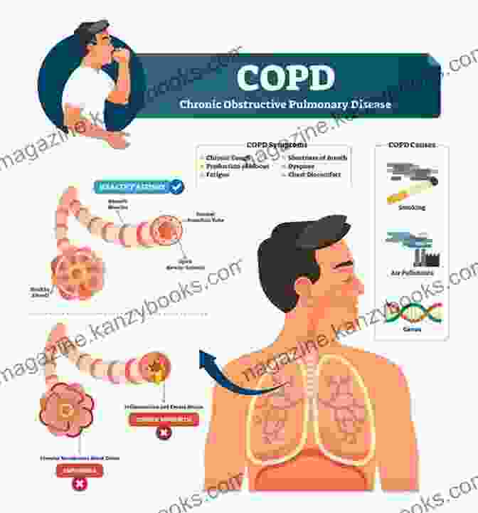 Image Showcasing Various Lung Diseases, Including Pneumonia, Bronchitis, And Emphysema. A Simple Guide To Asthma And Lung Diseases (A Simple Guide To Medical Conditions)