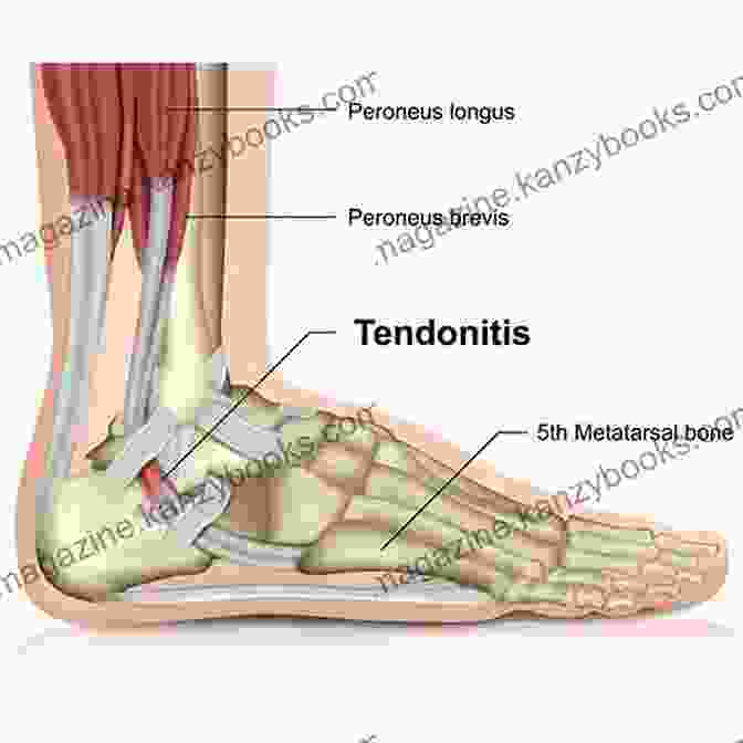 Inflamed Tendon With Clear Anatomical Details A Simple Guide To Inflamed Tendons (Tendonitis) Diagnosis Treatment And Related Conditions