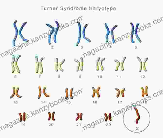 Karyotype Showing The Missing X Chromosome In Turner Syndrome A Simple Guide To Turner Syndrome Diagnosis Treatment And Related Conditions