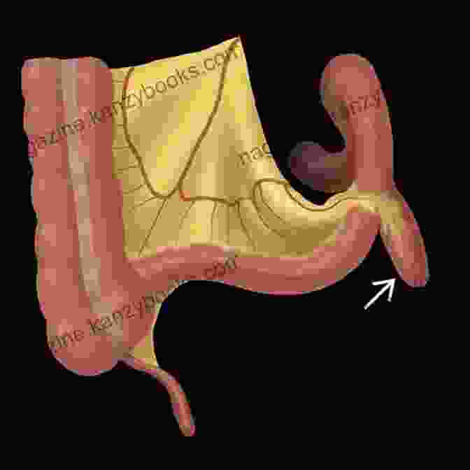 Meckel Diverticulum, A Small Pouch Protruding From The Small Intestine A Simple Guide To Meckel Diverticulum Diagnosis Treatment And Related Conditions