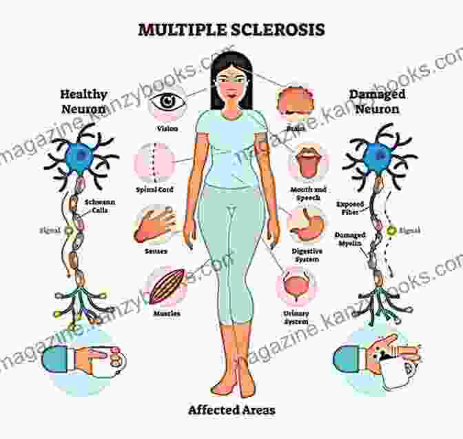 Multiple Sclerosis A Simple Guide To Multiple Sclerosis Treatment And Related Diseases (A Simple Guide To Medical Conditions)