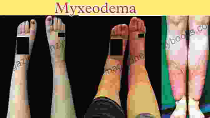 Symptoms Of Myxedema A Simple Guide To Myxedema Diagnosis Treatment And Related Conditions