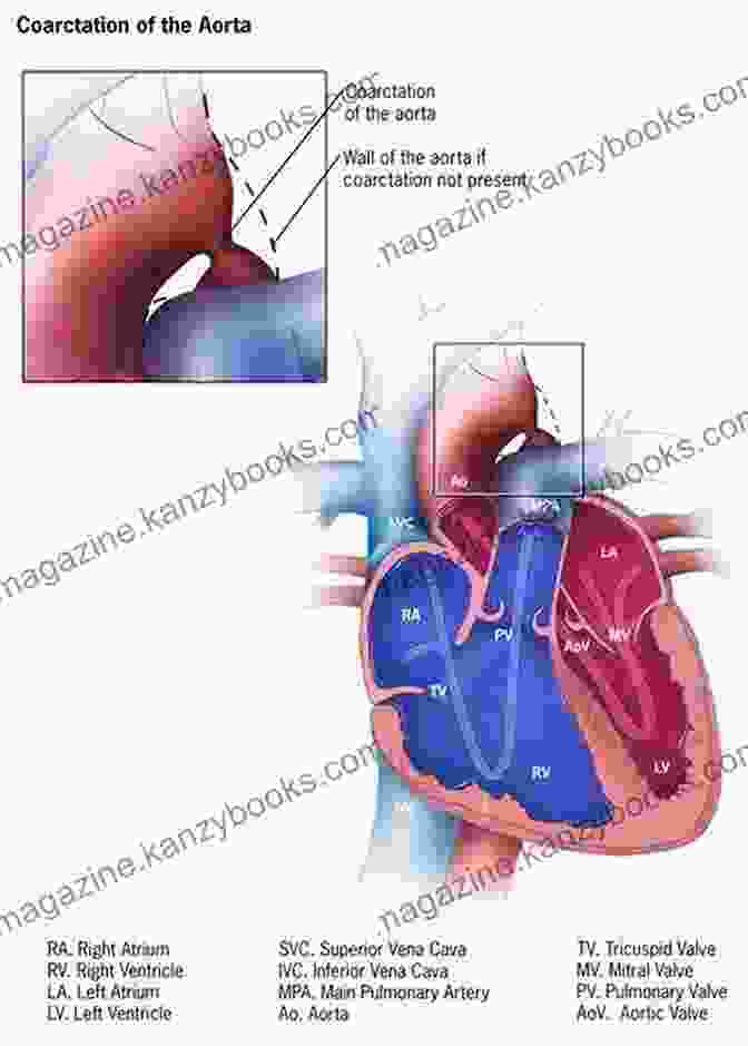 Ultrasound Image Revealing A Heart Defect Associated With Turner Syndrome A Simple Guide To Turner Syndrome Diagnosis Treatment And Related Conditions